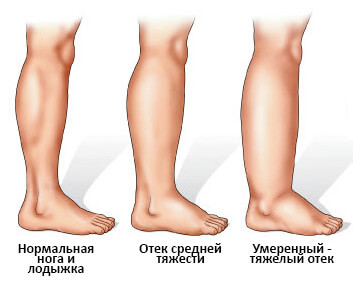 Сложности в выявлении вируса гепатита С- фото № 3 Сложности в выявлении вируса гепатита С