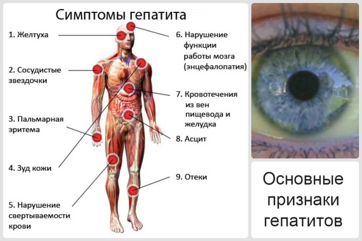 Как не стать жертвой вируса гепатита С?- фото № 2 Как не стать жертвой вируса гепатита С?