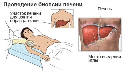 Биопсия при гепатите С это прошлый век?- фото № 2 Биопсия при гепатите С это прошлый век?